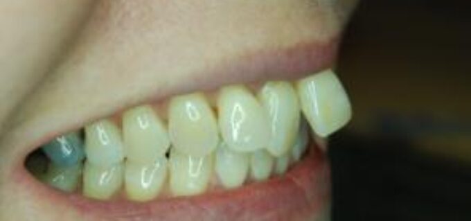 Before - seasidedental